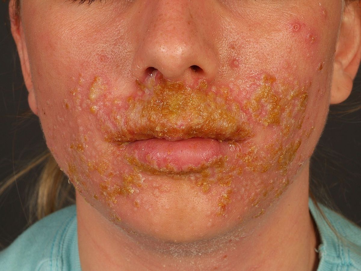 Impetigo Contagiosa Kleinblasige Altmeyers Enzyklopadie Fachbereich Dermatologie