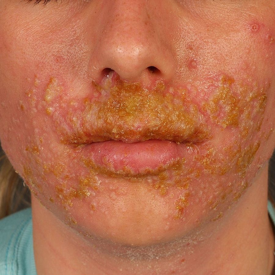 Impetigo Ubersicht Altmeyers Enzyklopadie Fachbereich Dermatologie