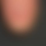 Melanonychia longitudinalis: Wide discrete brown longitudinal discoloration of the thumbnail; the...