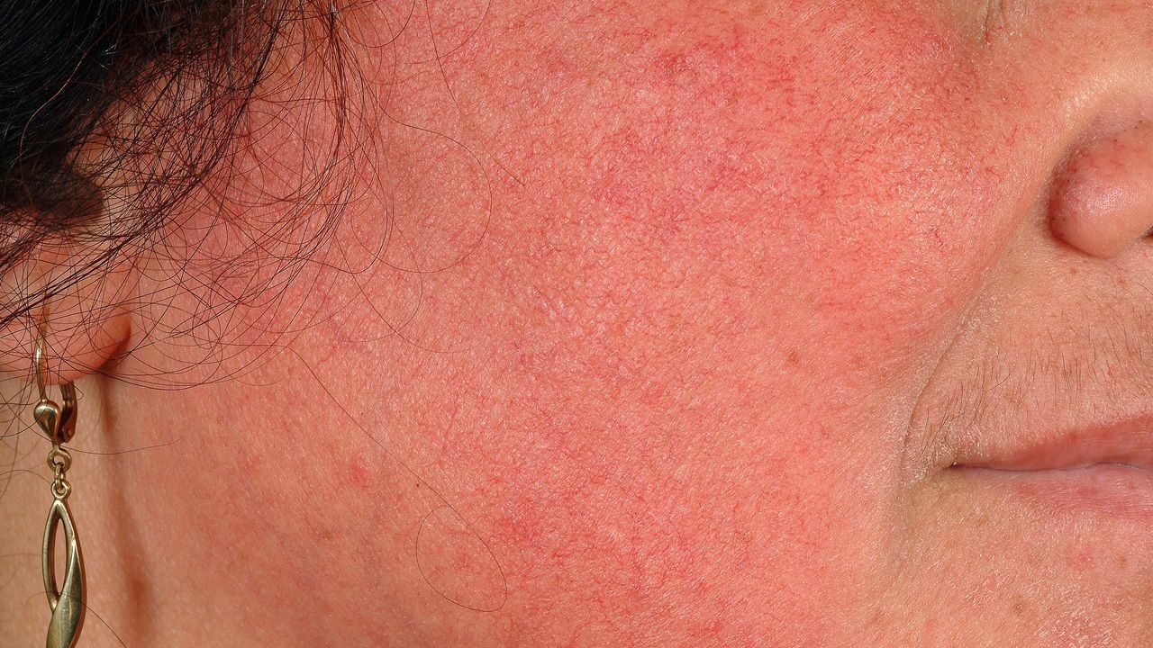 photo Alkoholiker Gesichtsrötung rosacea erythematosa altmeyers