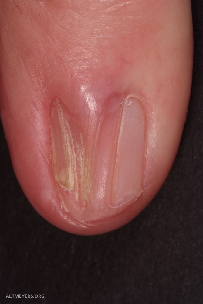 Dorsal pterygium - Altmeyers Encyclopedia - Department Dermatology Dorsal pterygium - Altmeyers Encyclopedia - Department Dermatology
