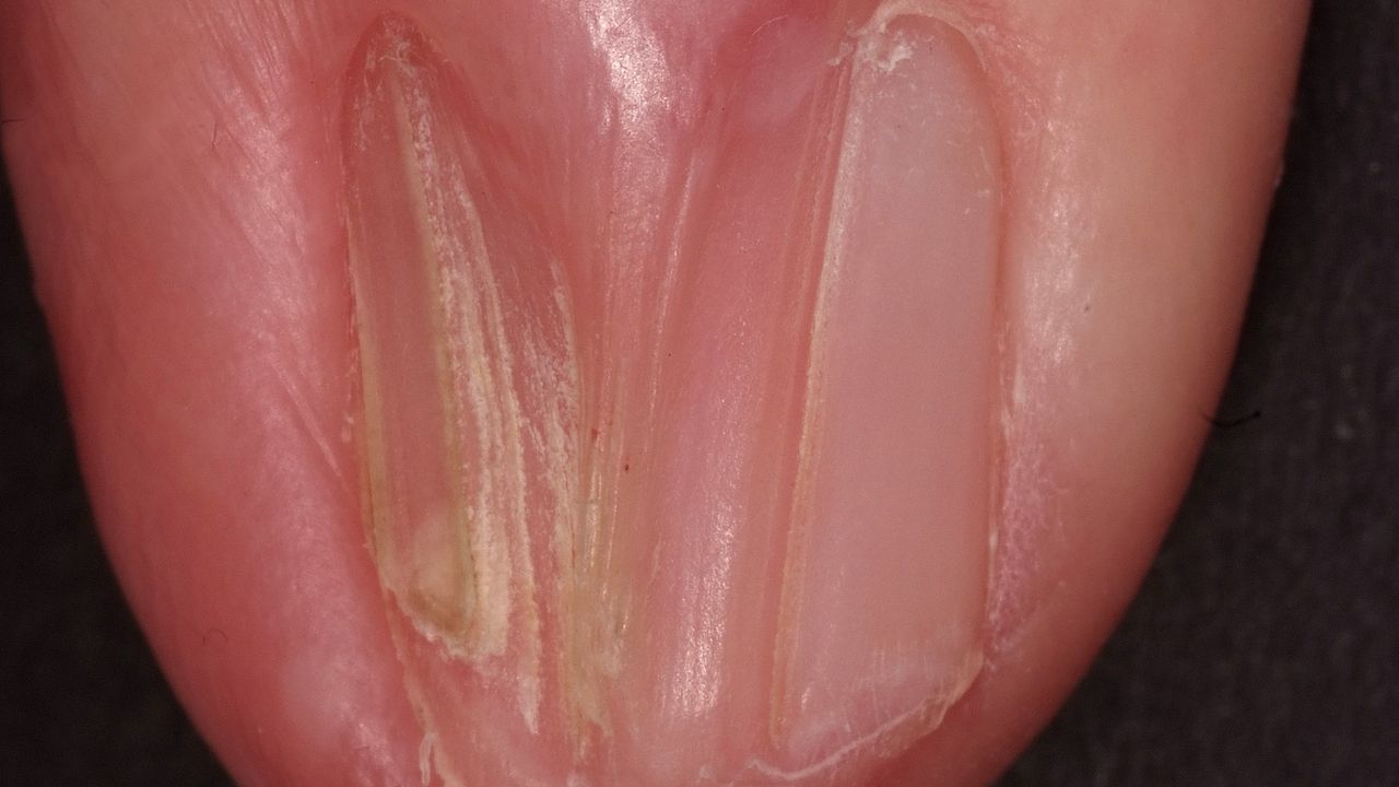 Dorsal pterygium - Altmeyers Encyclopedia - Department Dermatology Dorsal pterygium - Altmeyers Encyclopedia - Department Dermatology