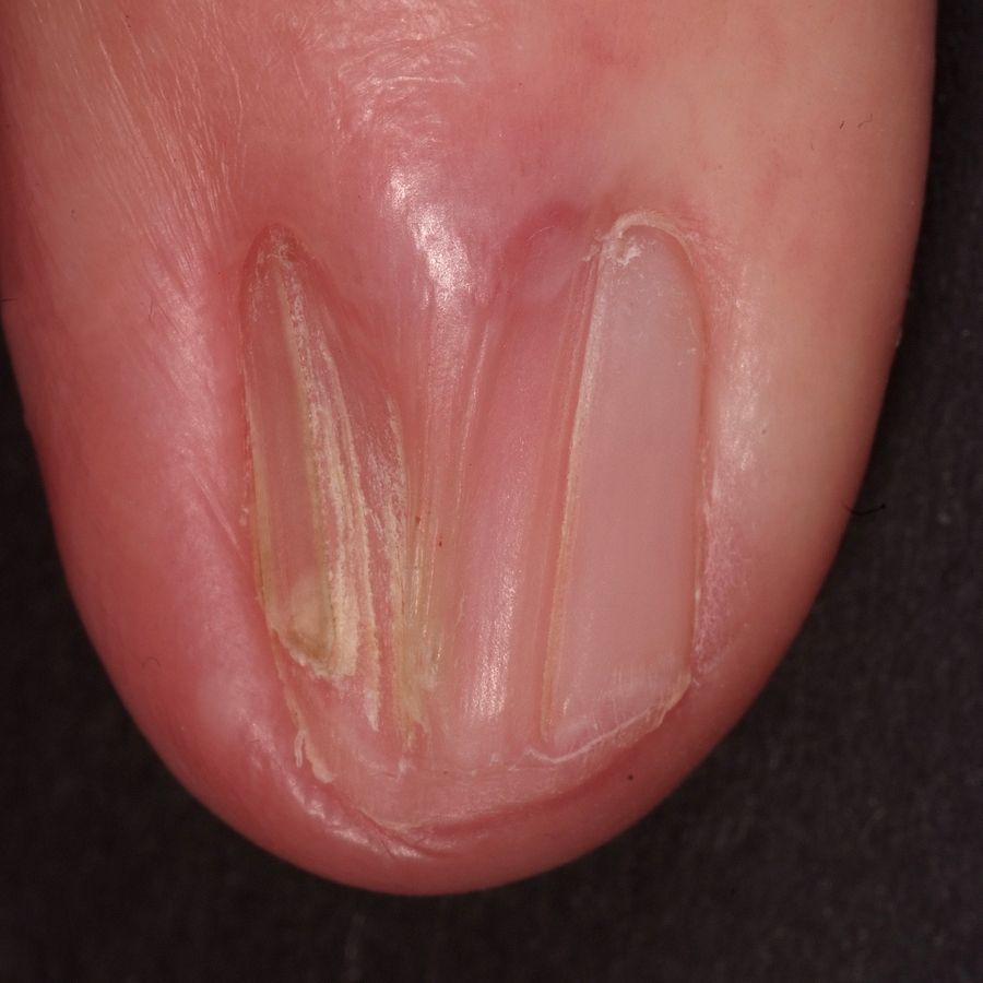 Dorsal pterygium - Altmeyers Encyclopedia - Department Dermatology Dorsal pterygium - Altmeyers Encyclopedia - Department Dermatology