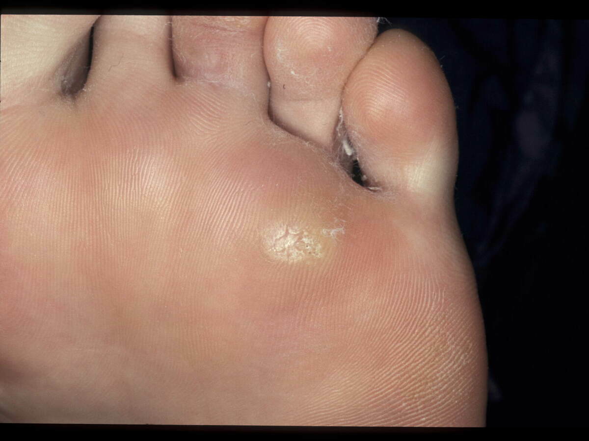 verruca vulgaris foot treatment