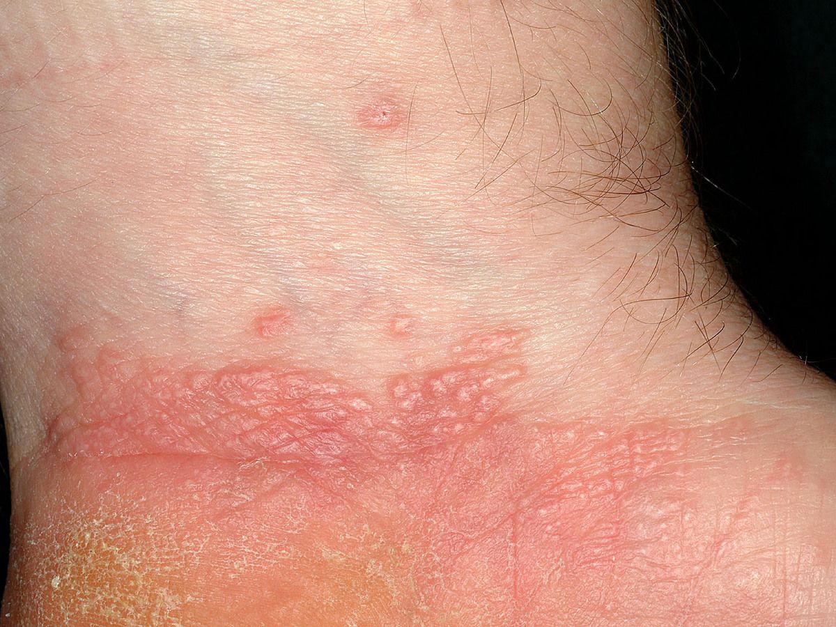 vesicular lichen planus