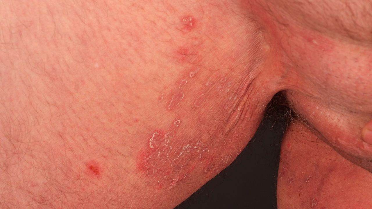 Tinea inguinalis   Altmeyers Enzyklopädie   Fachbereich Dermatologie