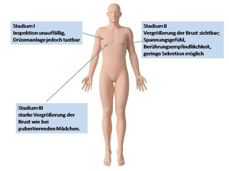 Gynecomastia a prostatitis alatt Vizelési késleltetés a férfiak prosztatitisben