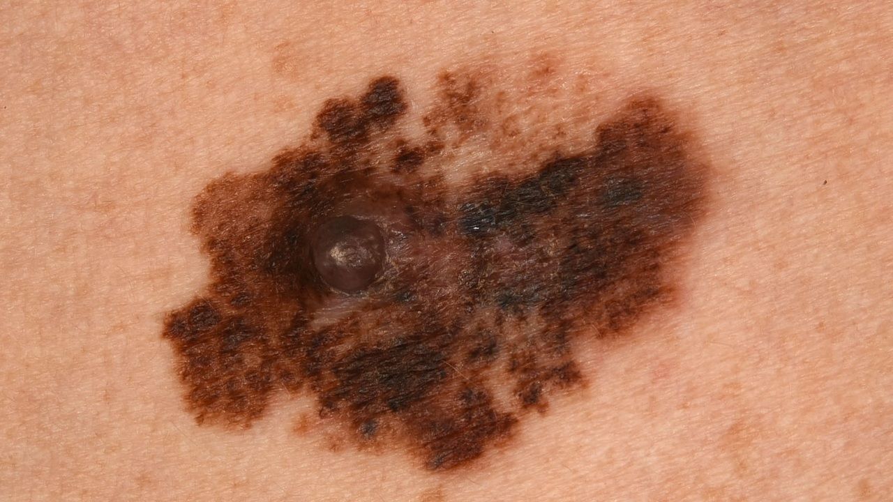 Melanom Altmeyers Enzyklopadie Fachbereich Dermatologie