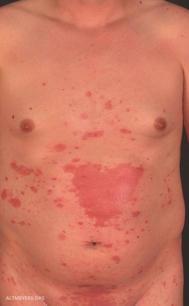 gyakori psoriasis vulgaris kezels