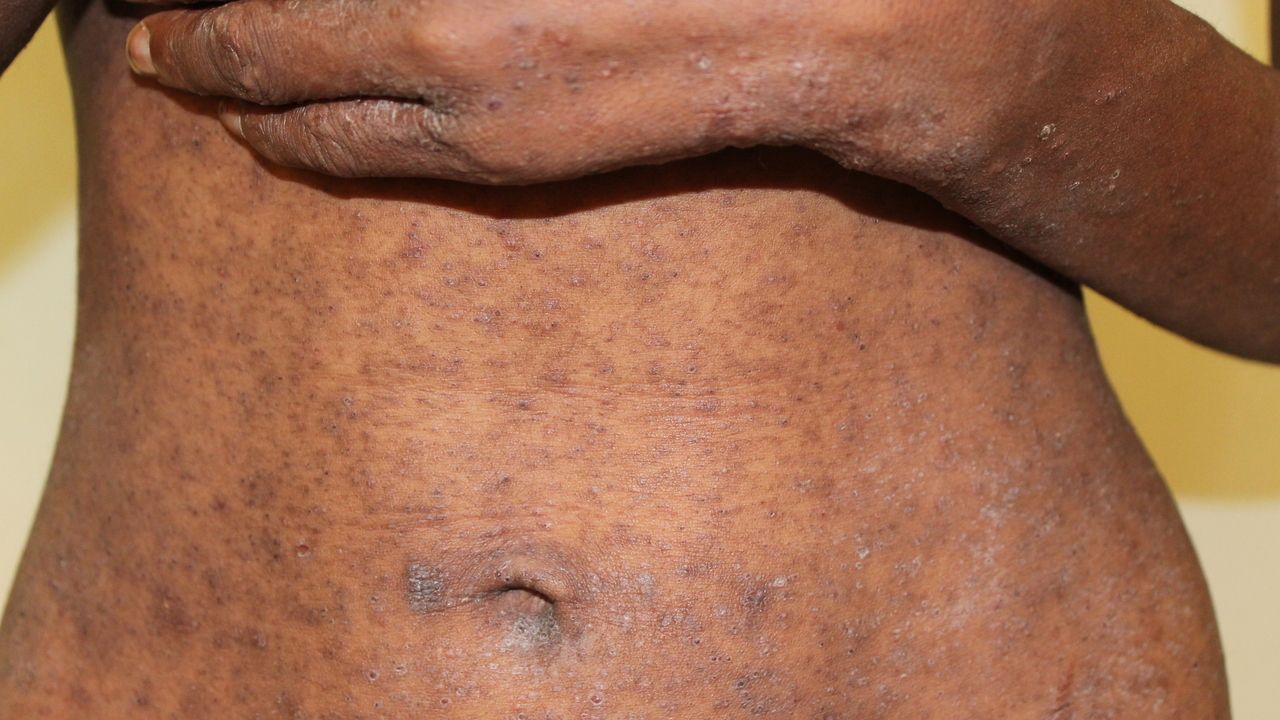 Scabies Rash on Black Skin: Symptoms and Treatment