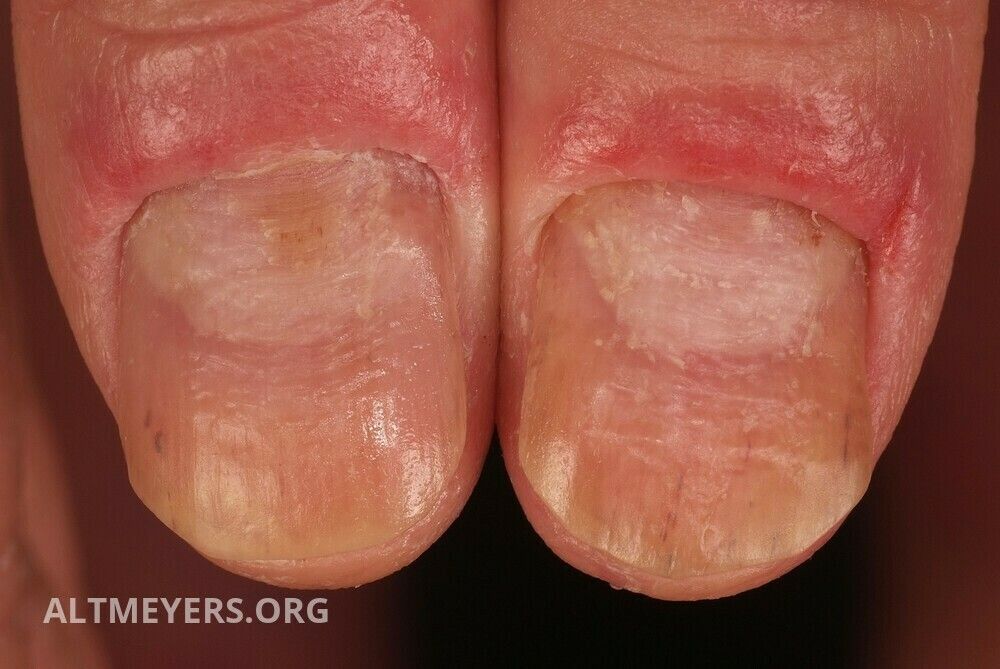 Nagelerkrankungen Ubersicht Altmeyers Enzyklopadie Fachbereich Dermatologie