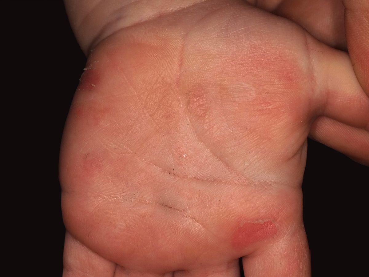 dermatitis herpetiformis palms