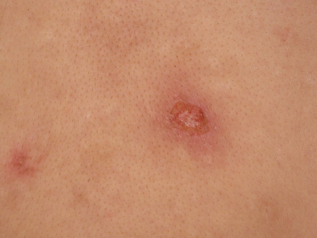 Follikulitis Superfizielle Altmeyers Enzyklopadie Fachbereich Dermatologie