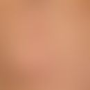 Lipoma: A subcutaneous lump which has existed for years, is completely unattractive and asymptoma...