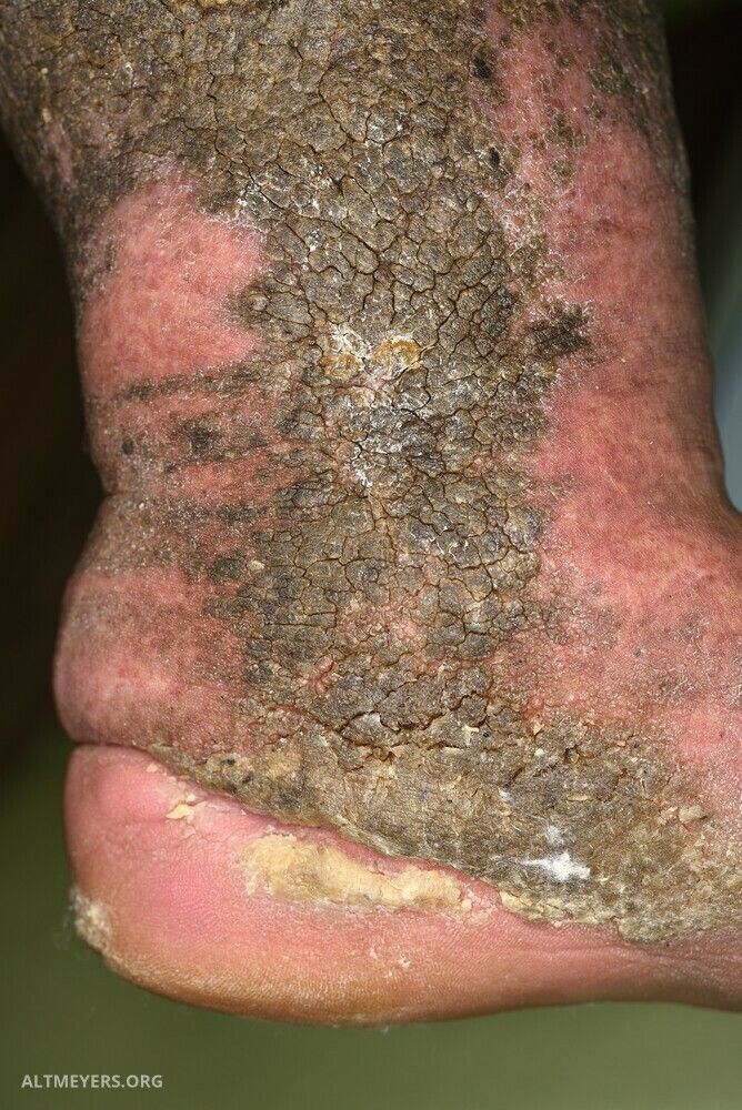 papillomatosis skin