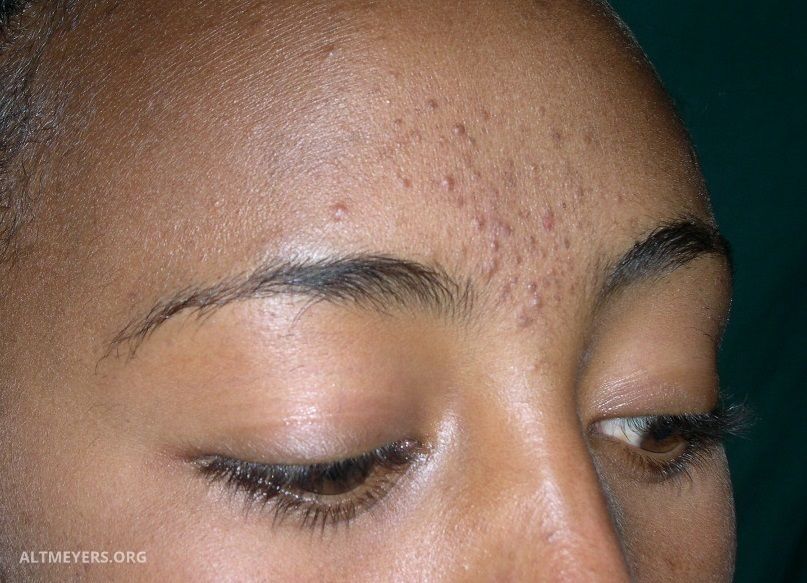 Acne Papulopustulosa Altmeyers Enzyklopadie Fachbereich Dermatologie