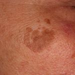 Keratose seborrhoische (Übersicht) - Altmeyers Enzyklopädie - Fachbereich Dermatologie