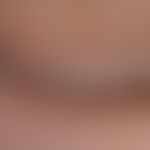 Vitiligo: Befall der Lider und des angrenzenden Wangebereichs. Fleckförmige Repigmentierung. Per ...