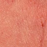 Lichenification - Altmeyers Encyclopedia - Department Dermatology