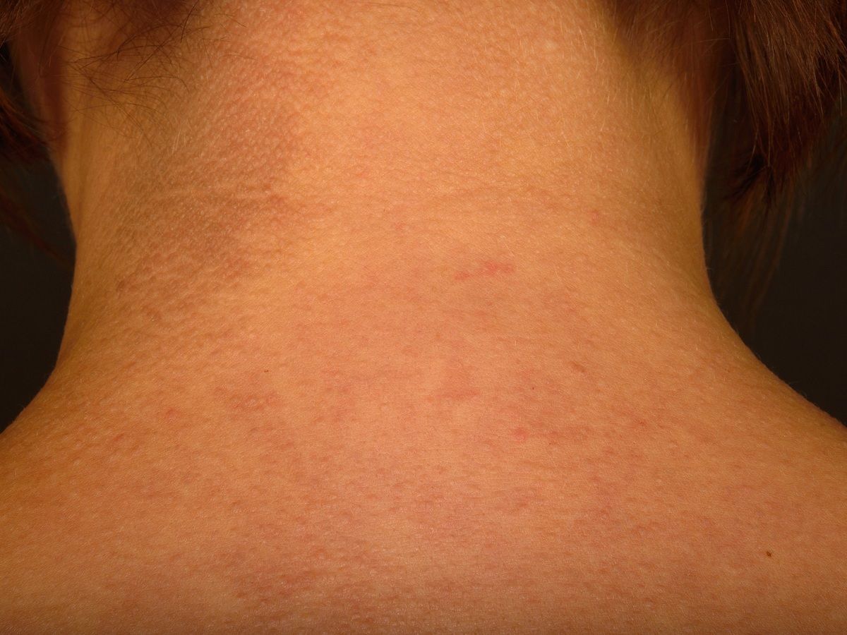 Acanthosis Nigricans Benigna Altmeyers Enzyklopadie Fachbereich Dermatologie