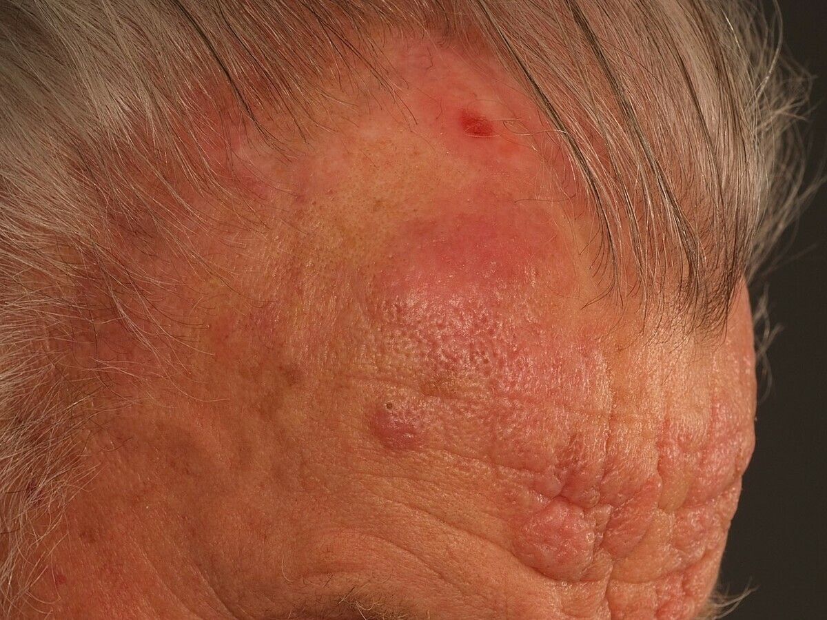 photo Mycosis Fungoides Tumor Stage Pictures mycosis fungoides tumor stadium