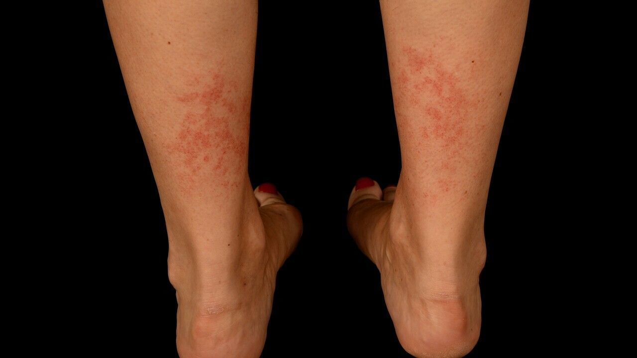 Purpura Thrombozytopenische Altmeyers Enzyklopadie Fachbereich Dermatologie