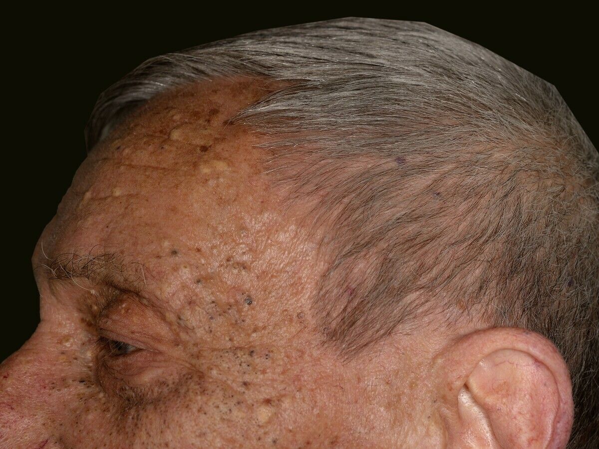 Elastoidosis Cutanea Nodularis Et Cystica Altmeyers Enzyklopadie Fachbereich Dermatologie