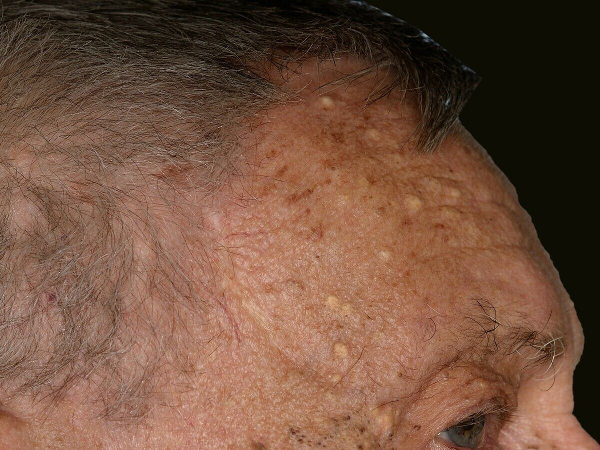 Elastoidosis Cutanea Nodularis Et Cystica Altmeyers Enzyklopadie Fachbereich Dermatologie