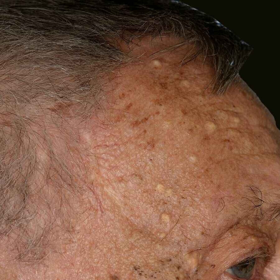 Elastoidosis Cutanea Nodularis Et Cystica Altmeyers Enzyklopadie Fachbereich Dermatologie