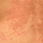 Dermatitis exudative discoid lichenoid - Altmeyers Encyclopedia ...