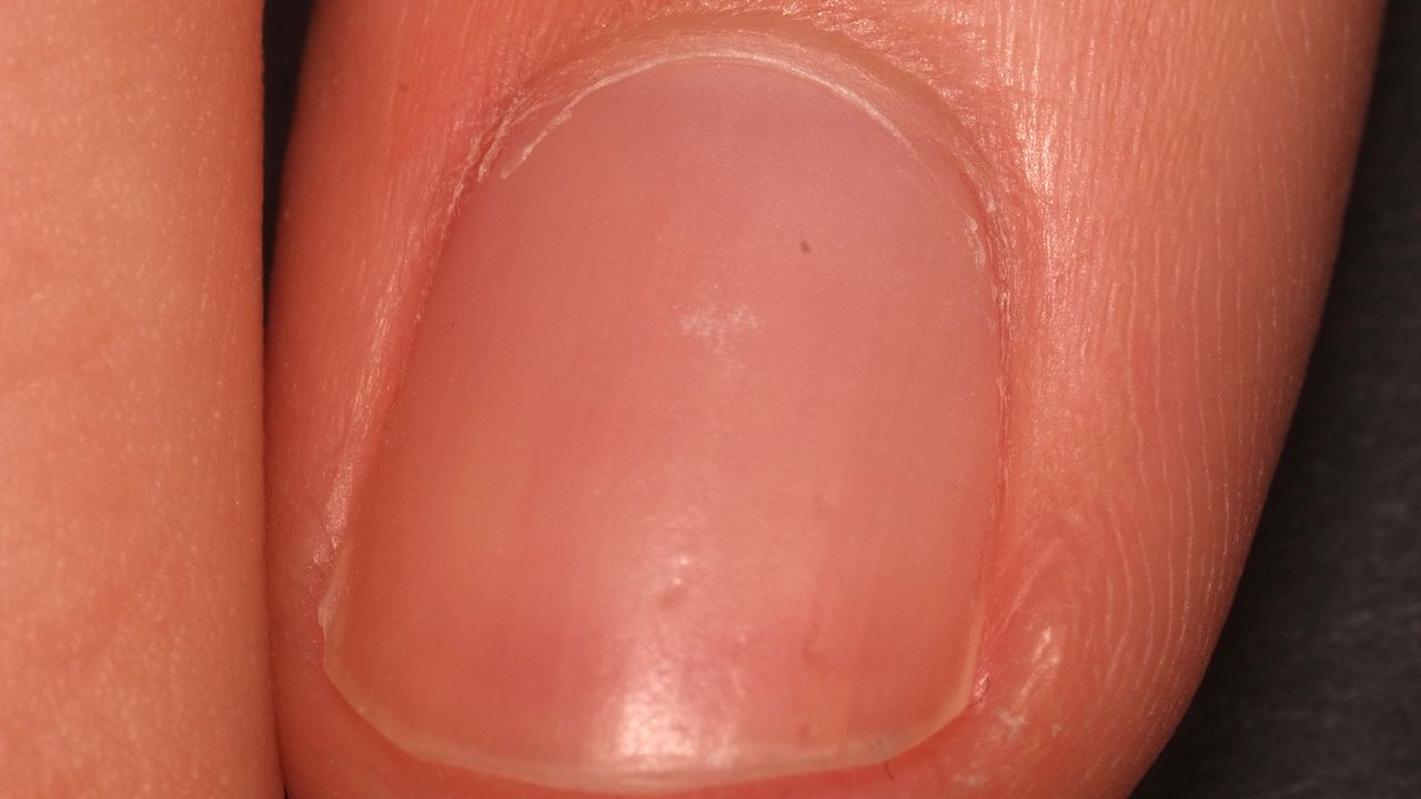 Nagelerkrankungen Ubersicht Altmeyers Enzyklopadie Fachbereich Dermatologie