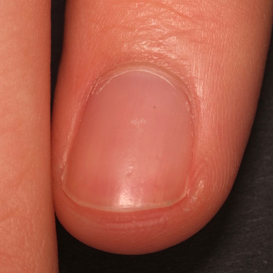 Nagelerkrankungen Ubersicht Altmeyers Enzyklopadie Fachbereich Dermatologie