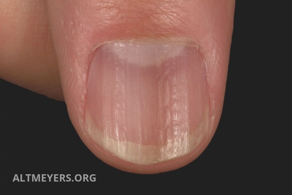 Nail diseases (overview) - Altmeyers Encyclopedia - Department Dermatology Nail diseases (overview) - Altmeyers Encyclopedia - Department Dermatology