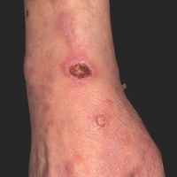 Ekthyma Images - Altmeyers Encyclopedia - Department Dermatology