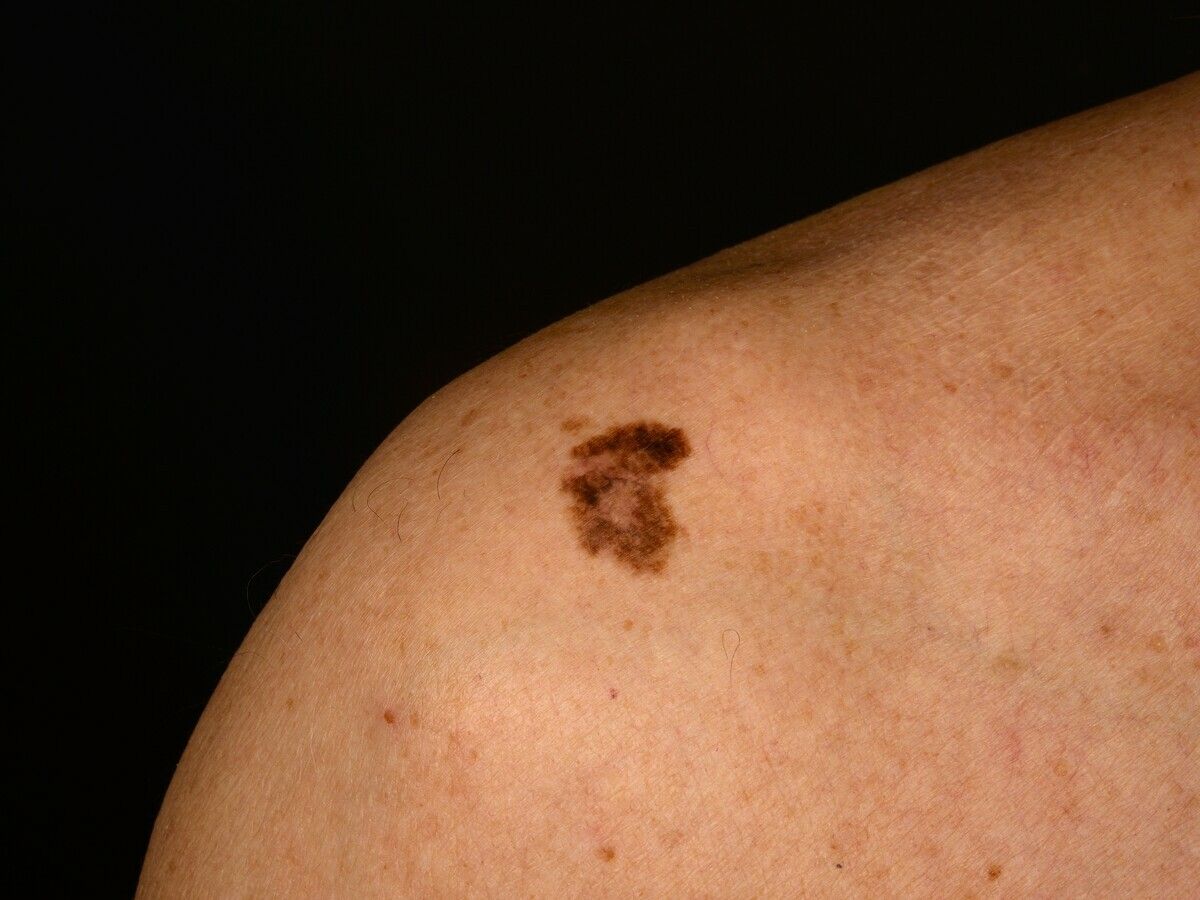Lentigo maligna - Altmeyers Encyclopedia - Department Dermatology