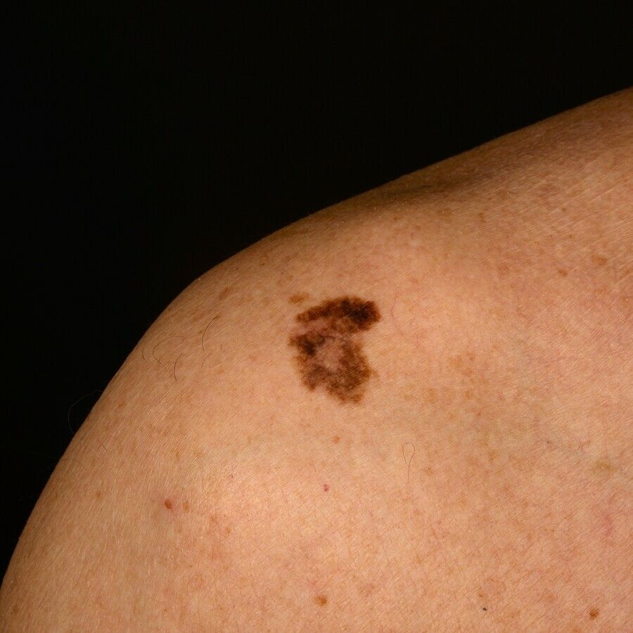 melanotic freckle of hutchinson hutchinson's treatment Lentigo Maligna Melanoma of the proximal nail