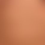 Urticaria pigmentosa: Übersichtsaufnahme: etwa 0,5-1,0cm große, disseminierte, ovale oder runde, ...