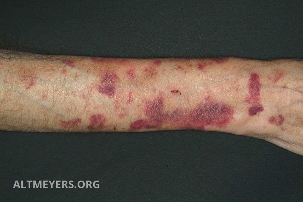 Der haut kleine einblutungen unter Purpura, Blutfleckenkrankheit