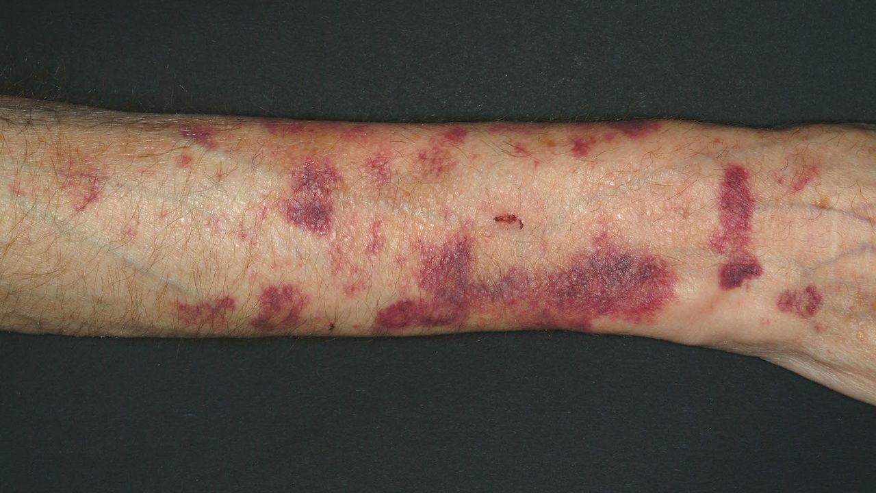 purpura on arms