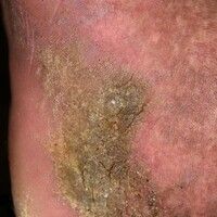 Papillomatosis Cutis Lymphostatica Images Altmeyers Encyclopedia papillomatosis-cutis-lymphostatica-images-altmeyers-encyclopedia