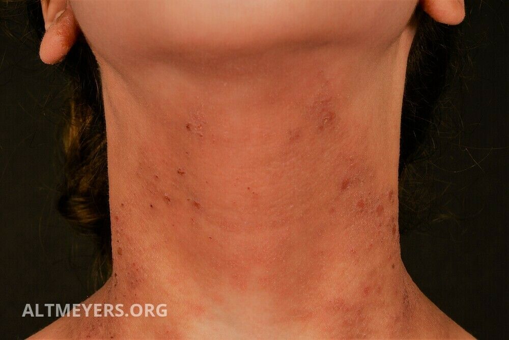 Atopische Dermatitis Ubersicht Altmeyers Enzyklopadie Fachbereich Dermatologie