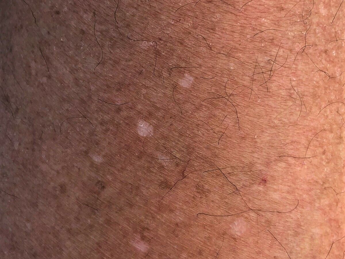 Hypomelanosis Guttata Altmeyers Enzyklopadie Fachbereich Dermatologie