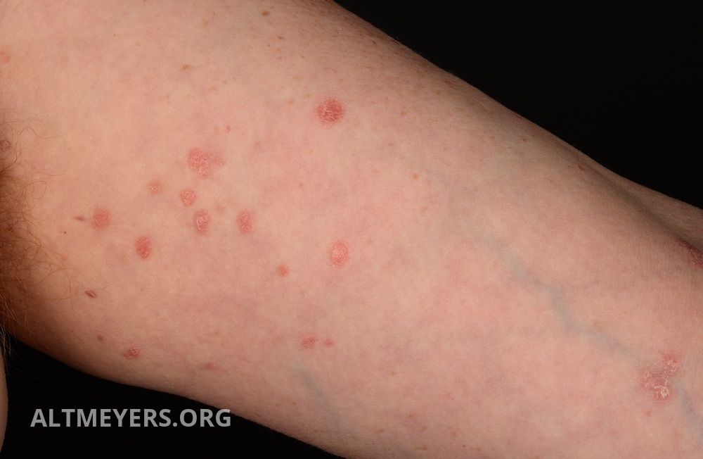 Hogyan lehet gyógyítani az oka a psoriasis