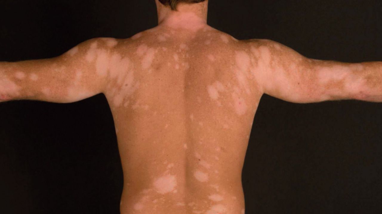 melanotan skin Love Island generation' skin cancer fear main image 1