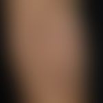 Erythrokeratodermia progressiva symmetrica: flächenhafte braun verfärbte, schuppende und verhärte...