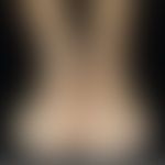 Erythrokeratodermia progressiva symmetrica: flächenhafte braun verfärbte, schuppende und verhärte...