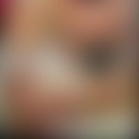 Pemphigoid bullöses im Säug... Pemphigoid bullöses im Säuglingsalter: schwer verlaufendes Bullöses Pemphigoid mit akral betonter...