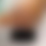 Dyshidrosiformes bullöses Pemphigoid: massiver großblasiger Befall des Vorfußes. Abb. entnommen a...