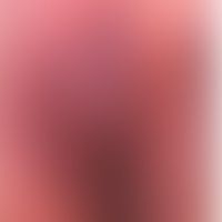 Pemphigoid vegetans: 9-jähr... Pemphigoid vegetans: 9-jähriges Mädchen mit rezdivierenden, verrukösen Plaques der Vulva. Abb.ent...