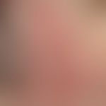Granuloma faciale: Mann, 48 Jahre. seit 2020 ortsstabil isoliert nur rechte Schläfe sub. symptoml...